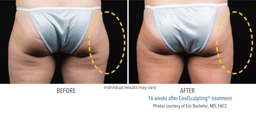 coolsculpting_before_and_after_foreveryoung-1024x459