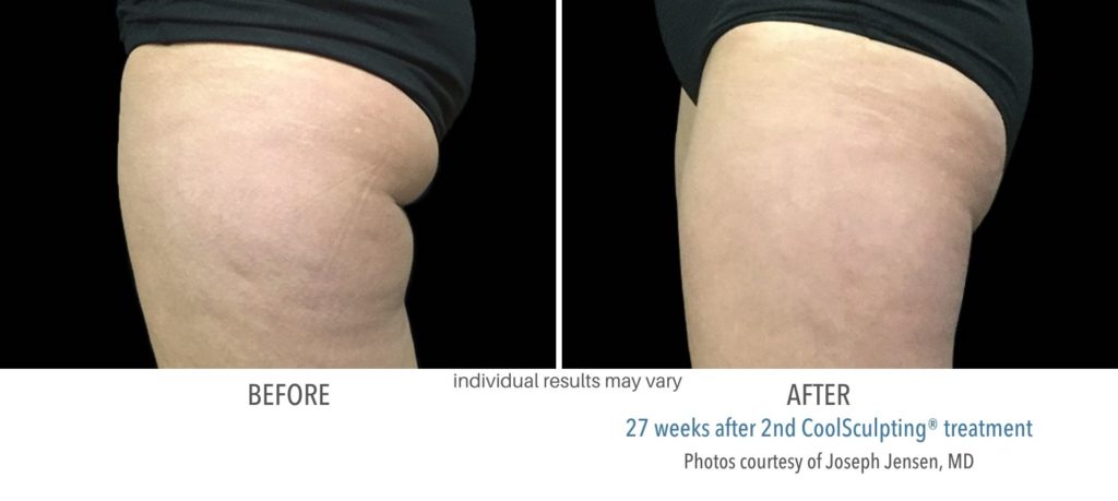 coolsculpting_before_and_after_foreveryoung_medspa-1024x459