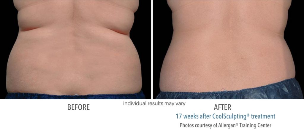coolsculpting_before_and_after_images-1024x459