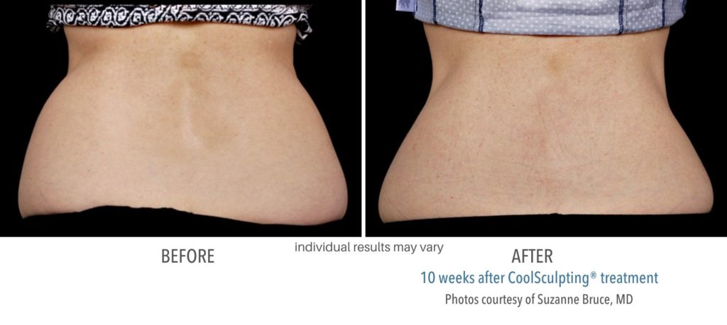 coolsculpting_before_and_after_picture-1024x459