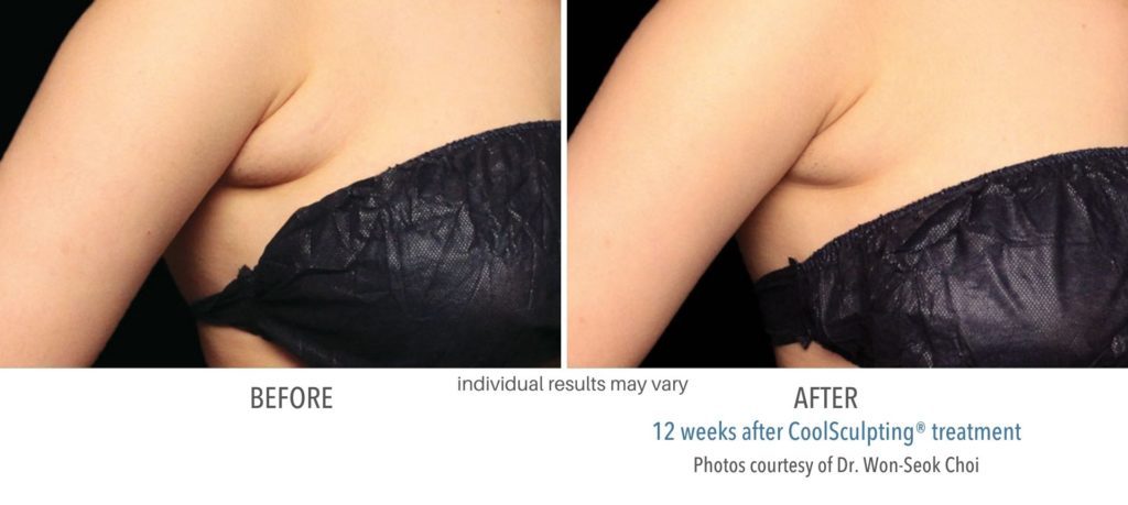 coolsculpting_before_and_after_results-1024x459