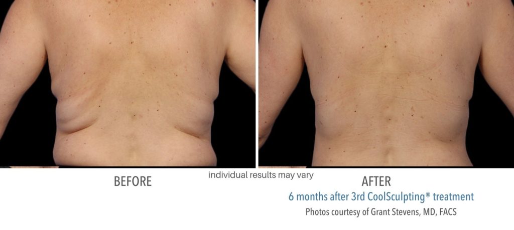 coolsculpting_before_and_after_treatment-1024x459