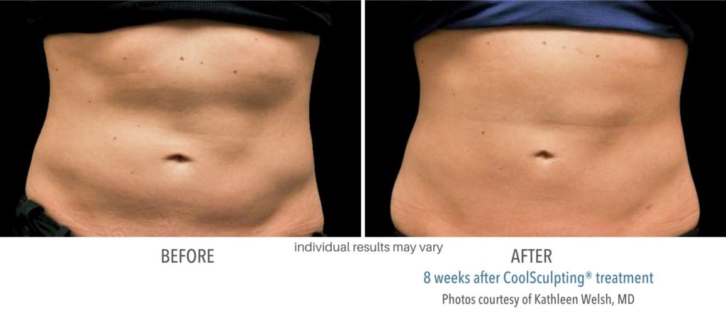 coolsculpting_before_and_after_treatment_result-1024x459