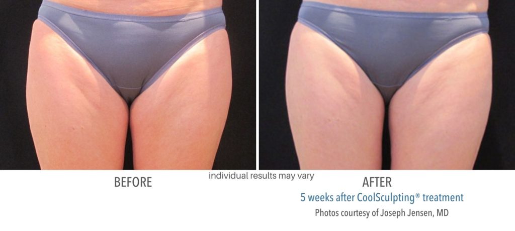 coolsculpting_treatment_areas_before_and_after_pictures-1024x459