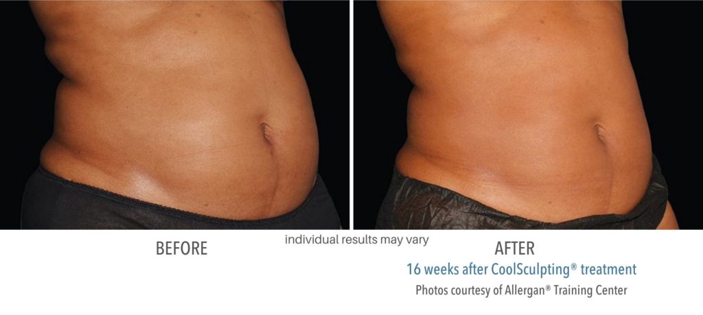 coolsculpting_treatment_before_and_after-1024x459
