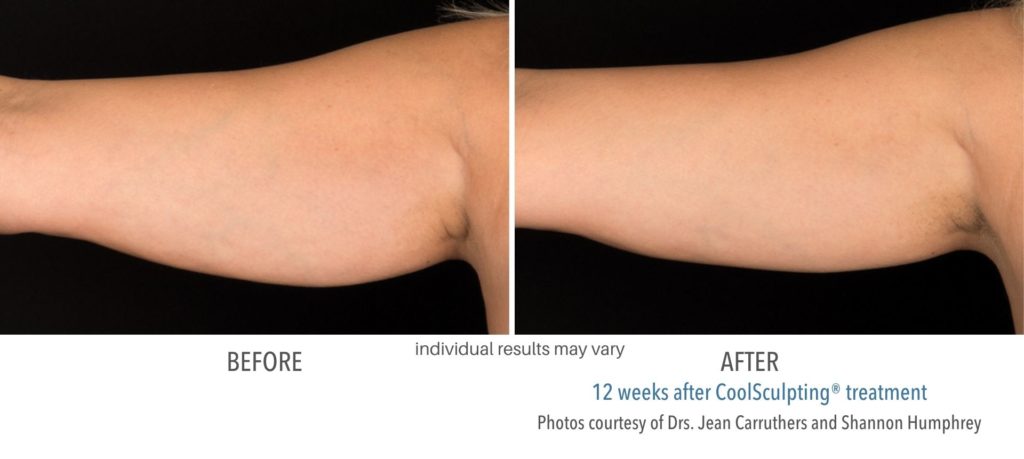 coolsculpting_treatment_before_and_after_foreveryoung-1024x459