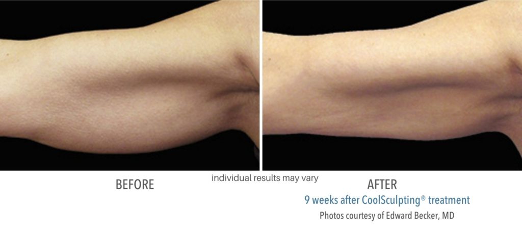 coolsculpting_treatment_before_and_after_images-1024x459