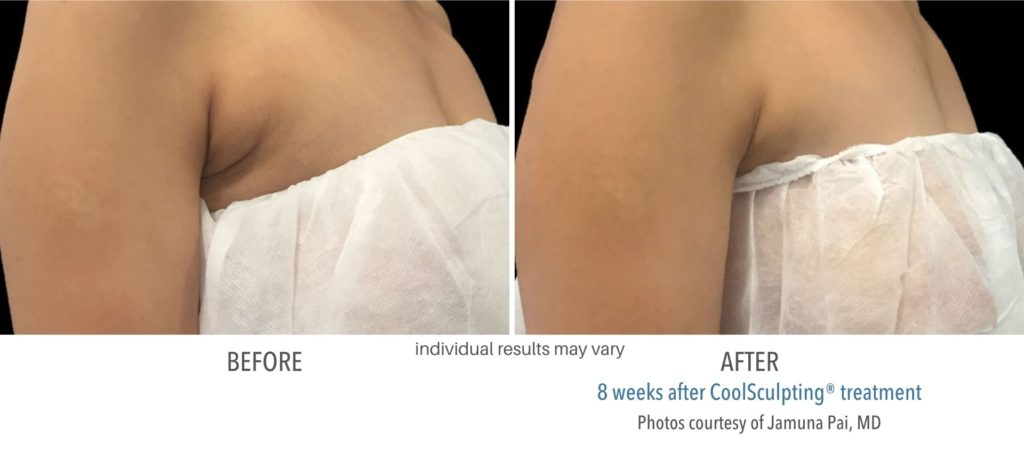 coolsculpting_treatment_before_and_after_result-1024x459