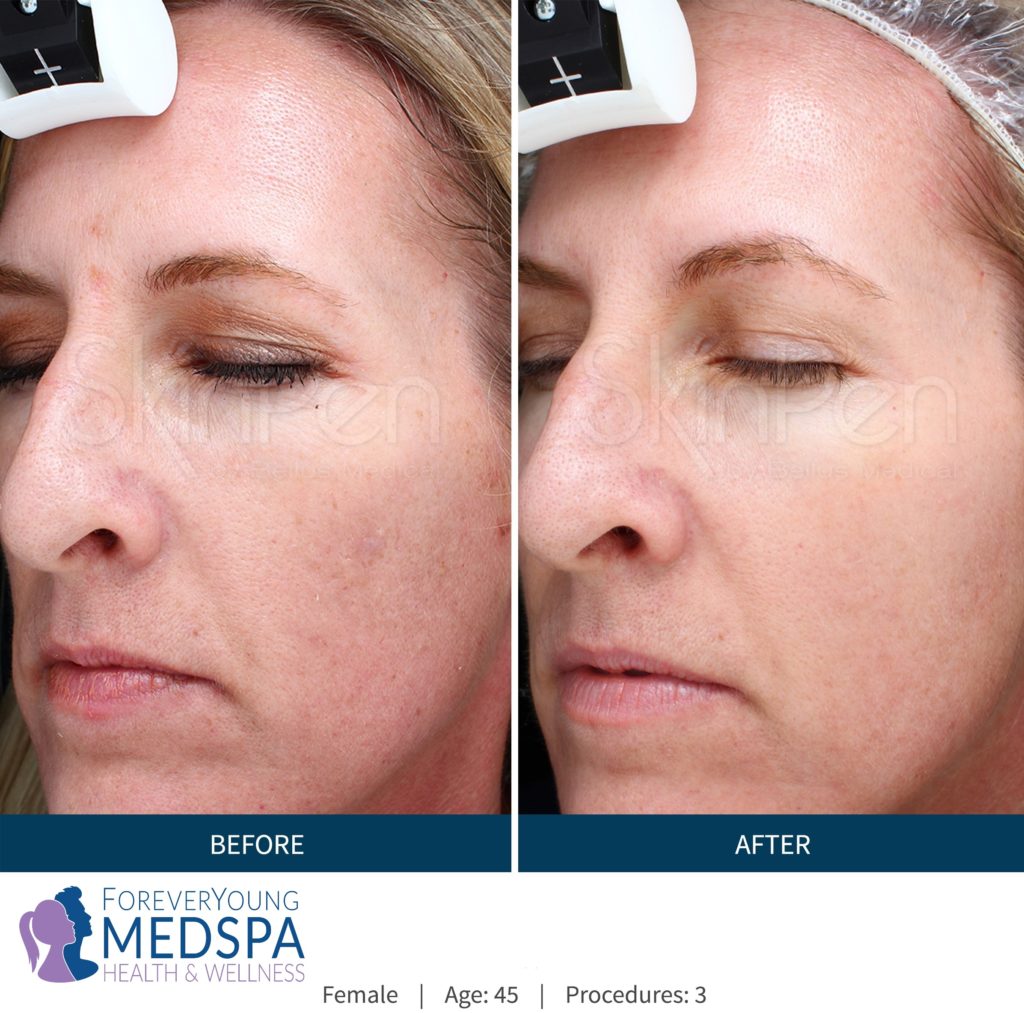 Before-and-After-microneedling1