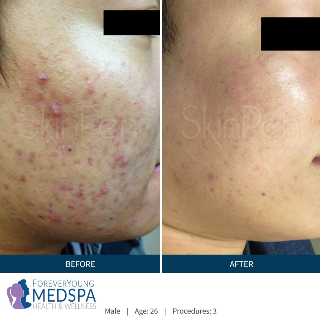 Before-and-After-microneedling2