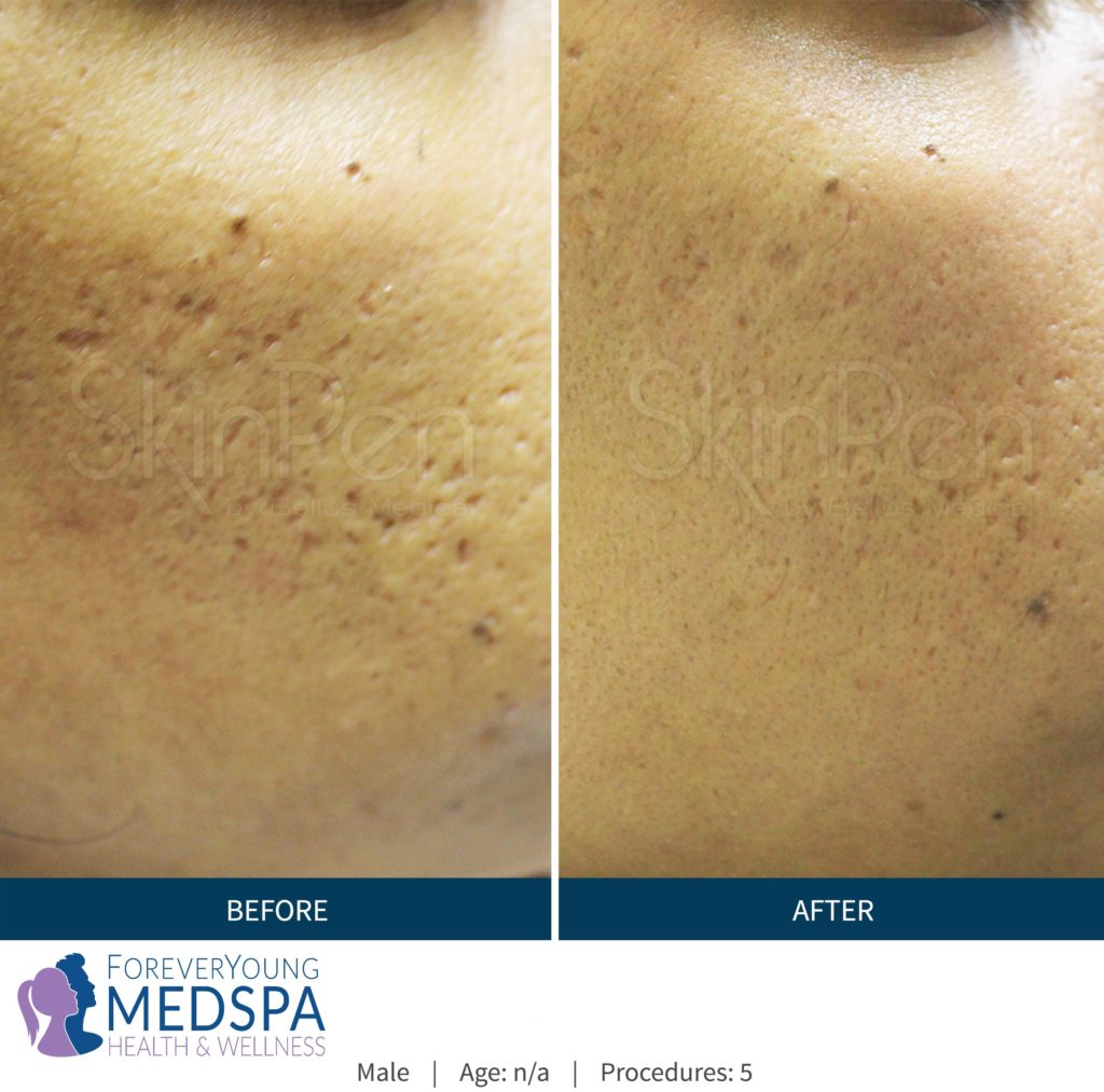 Before-and-After-microneedling3