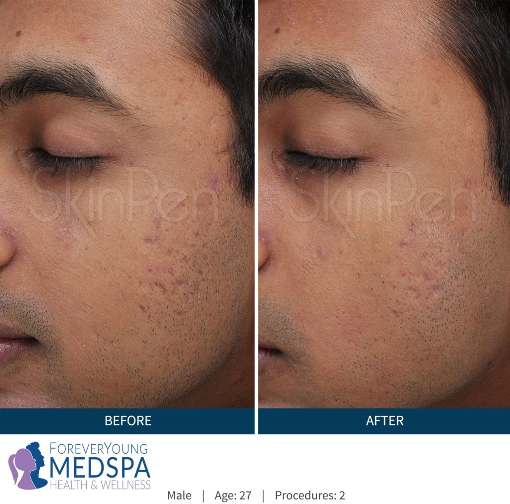 Before-and-After-microneedling4