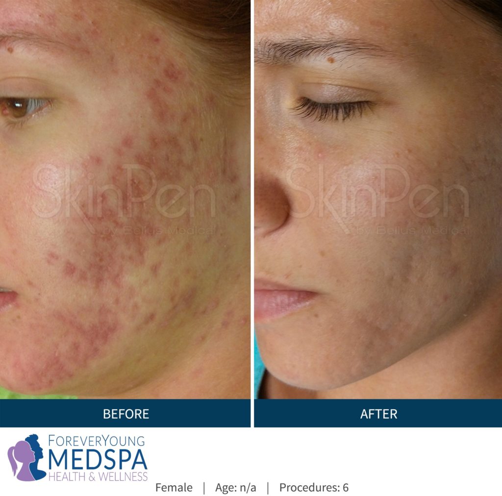 Before-and-After-microneedling5