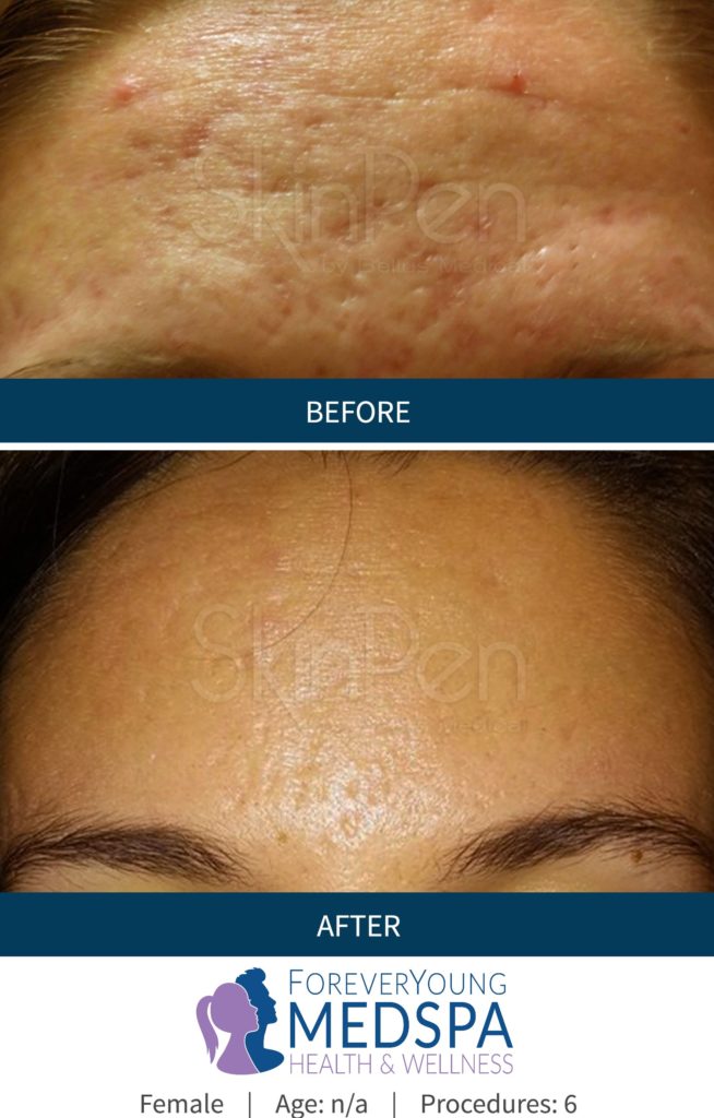 Before-and-After-microneedling6