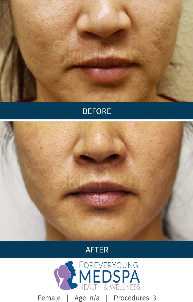 Before-and-After-microneedling7