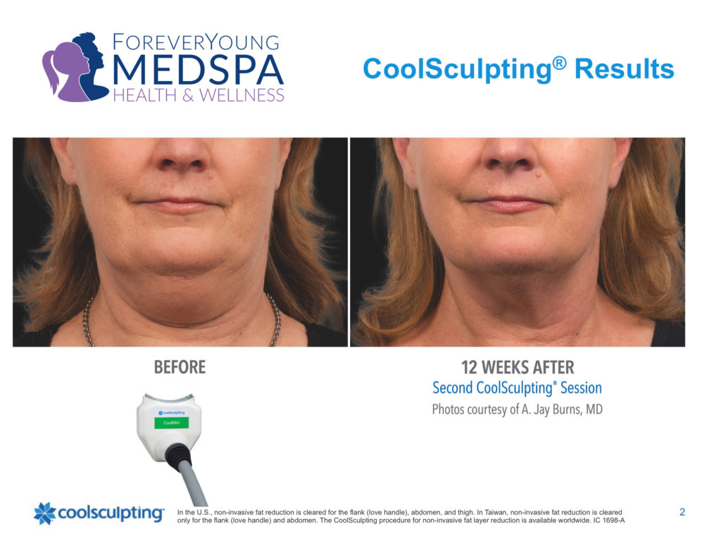 CoolSculpting Elite Liposuction Process in Lincolnwood, Illinois before and after treatment to neck area photo