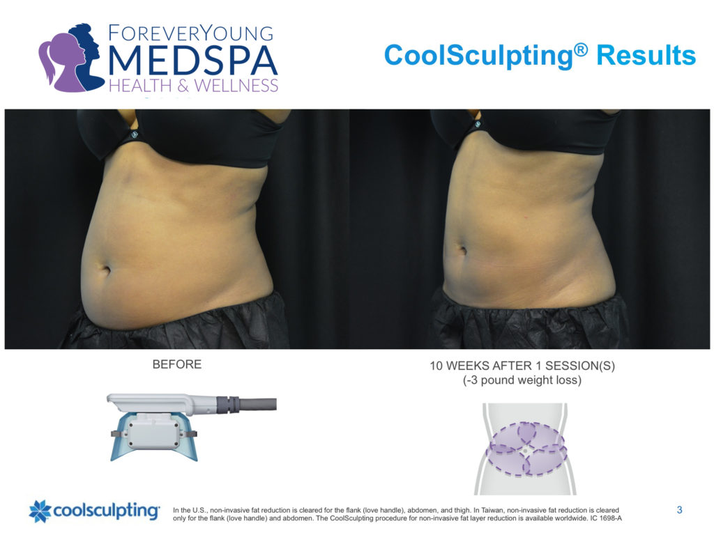 Before and after CoolSculpting treatment to abdomen area.
