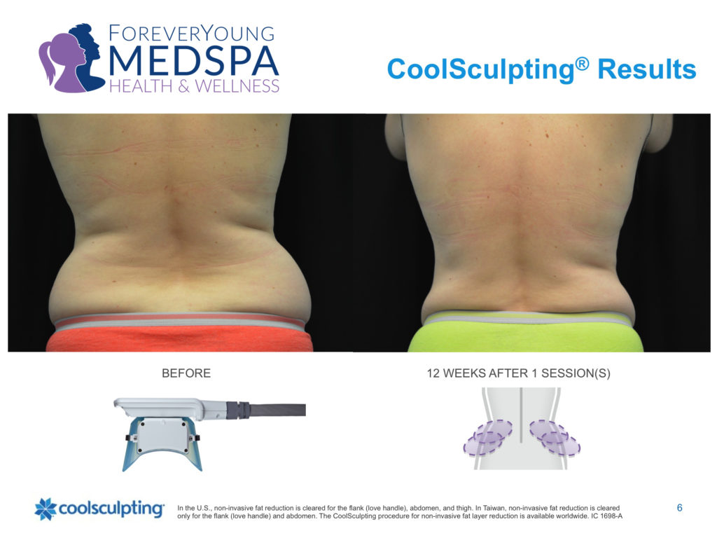 Before and after coolsculpting treatment to side flank area.