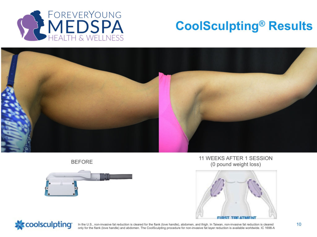 Before and after coolsculpting treatment to under arm area.
