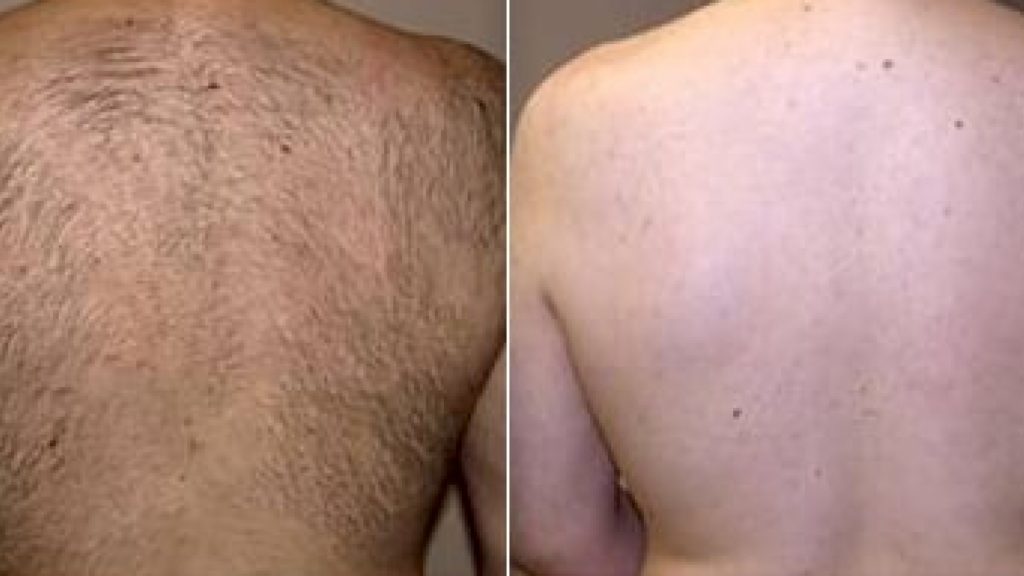 Laser-Hair-Removal-before-and-after1