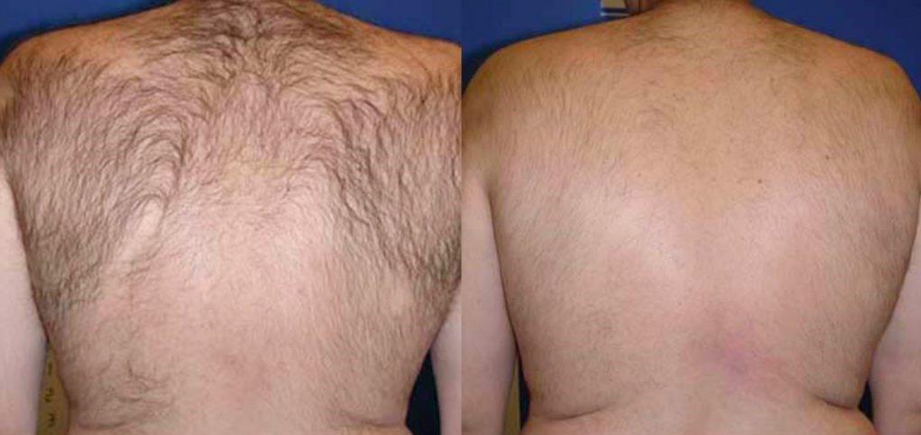 Laser-Hair-Removal-before-and-after2