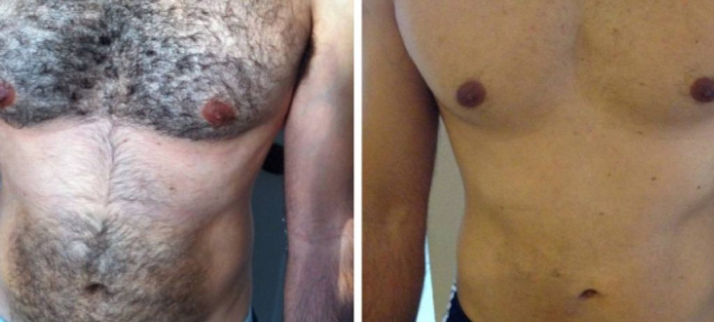 Laser-Hair-Removal-before-and-after3