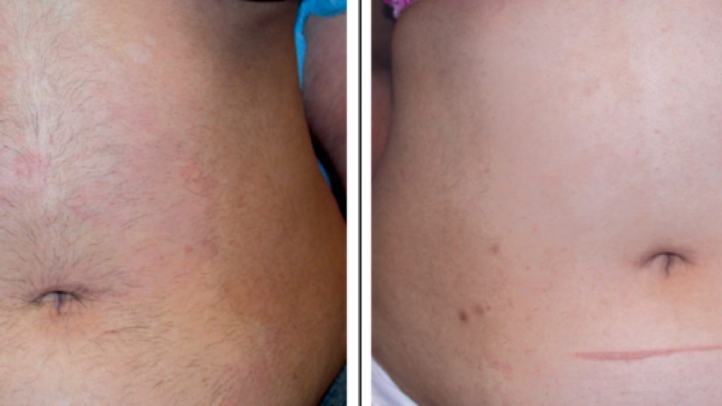 Laser-Hair-Removal-before-and-after4