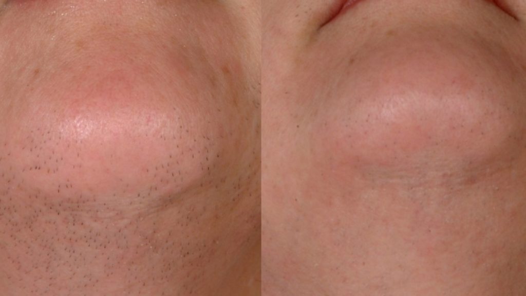 Laser-Hair-Removal-before-and-after5