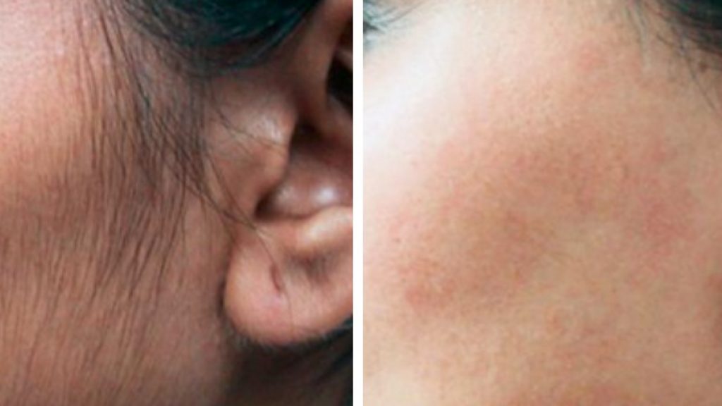 Laser-Hair-Removal-before-and-after8