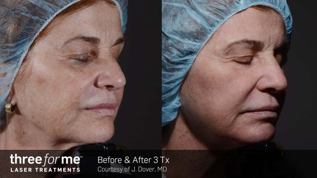 ThreeForMe-before-and-after-treatment1