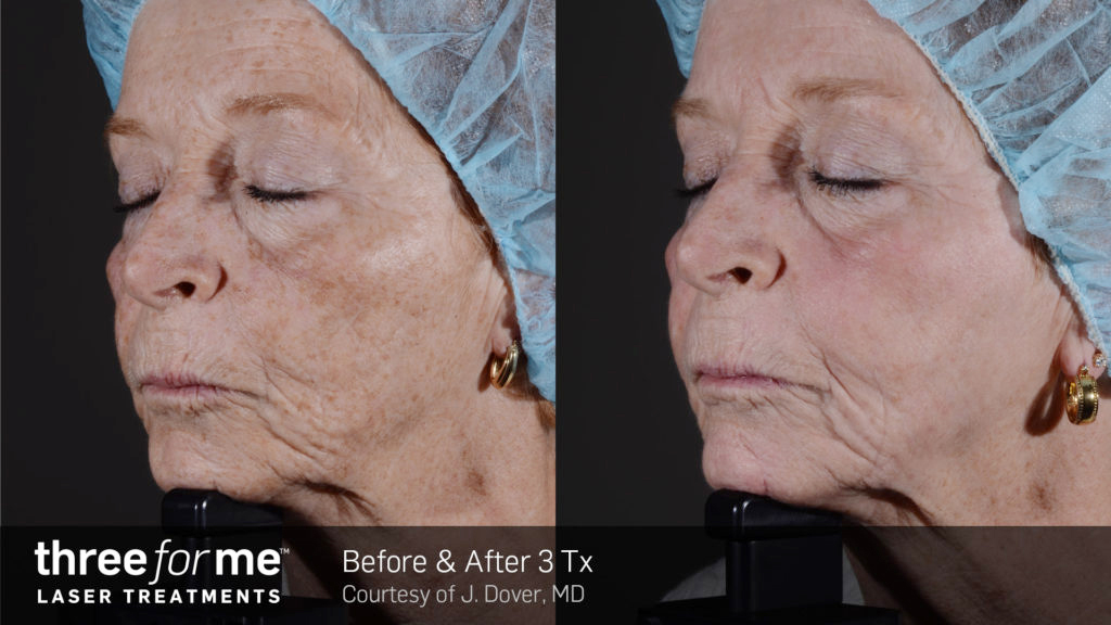 ThreeForMe-before-and-after-treatment2