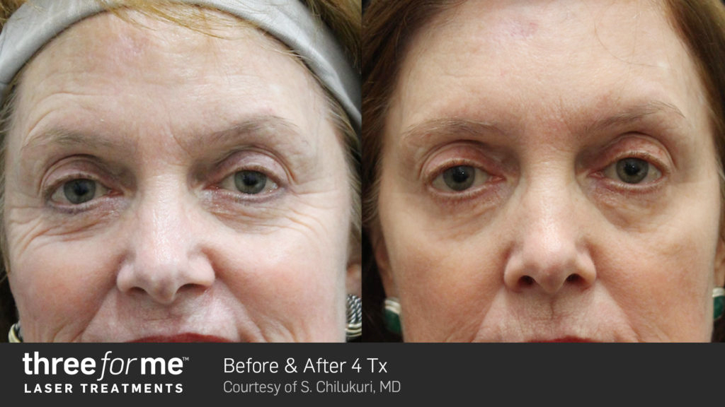 ThreeForMe-before-and-after-treatment3