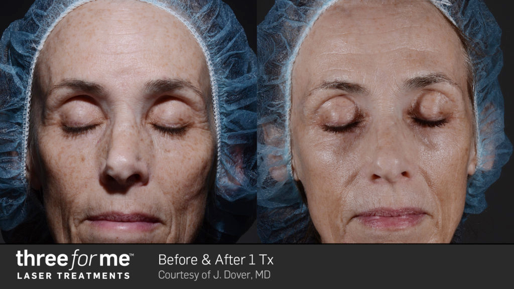 ThreeForMe-before-and-after-treatment5