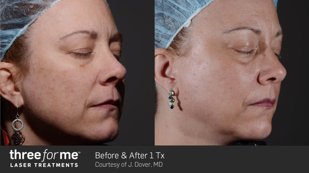 ThreeForMe-before-and-after-treatment6