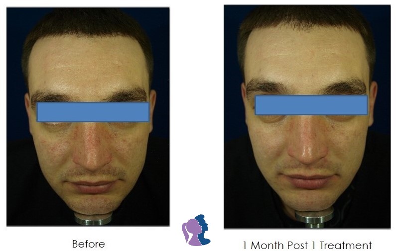 Man's before and after photofacial treatment at Forever Young Medspa.