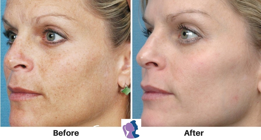 Woman's before and after photofacial treatment at Forever Young Medspa.