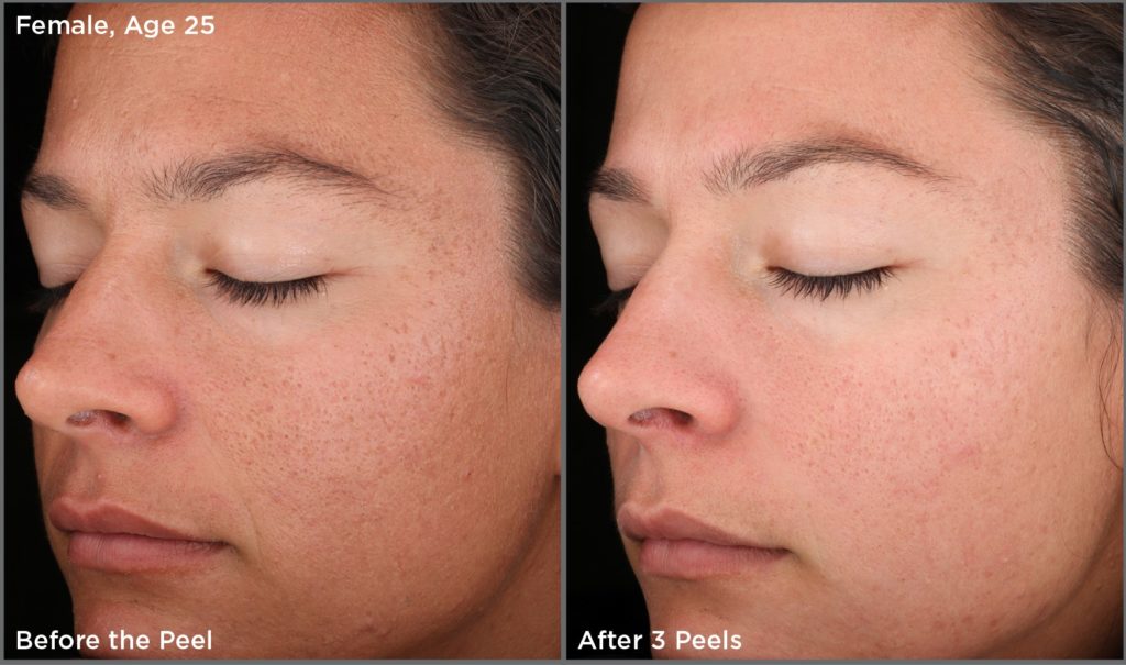 before-and-after-chemical-peel-treatment1