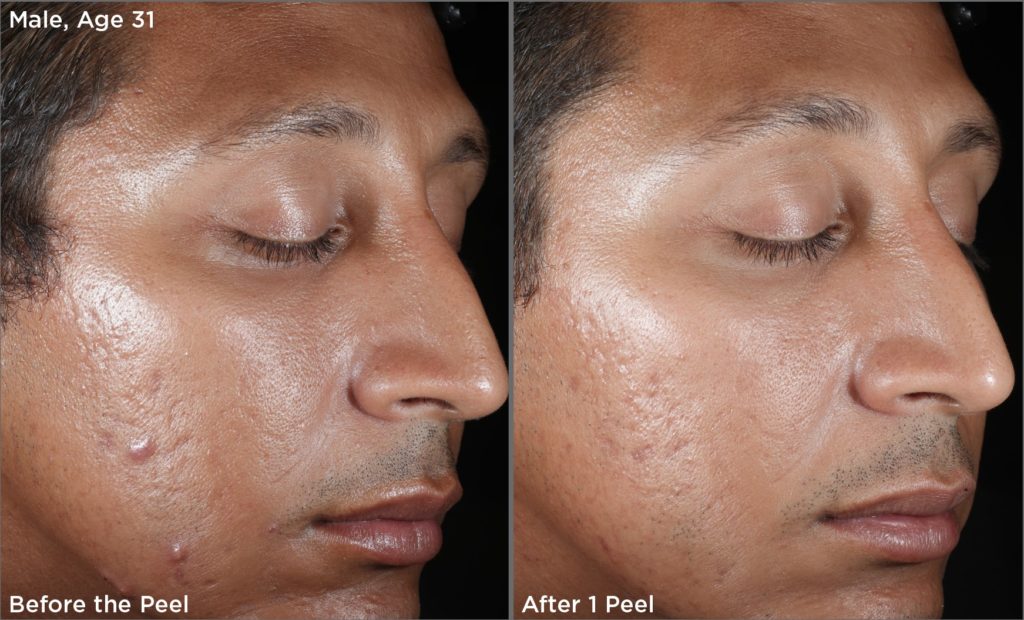 before-and-after-chemical-peel-treatment2