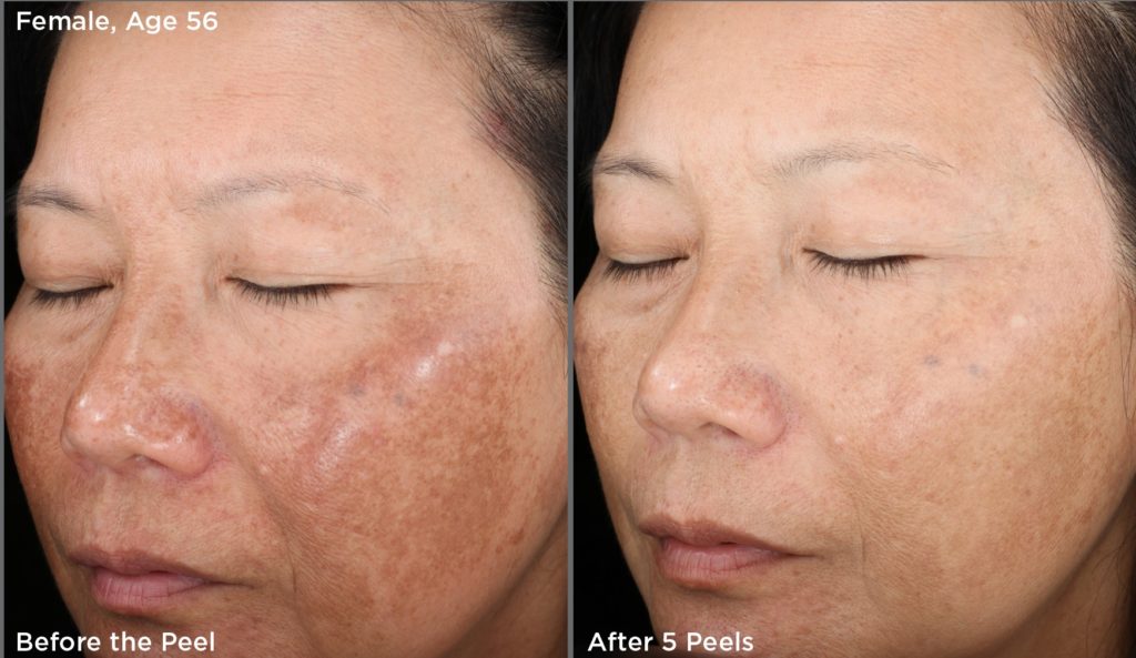 before-and-after-chemical-peel-treatment3