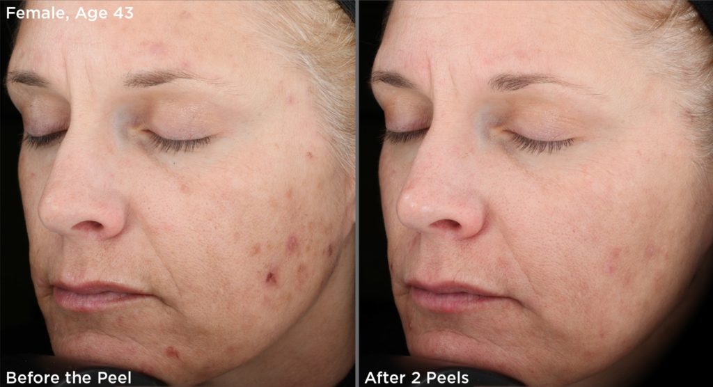 before-and-after-chemical-peel-treatment4