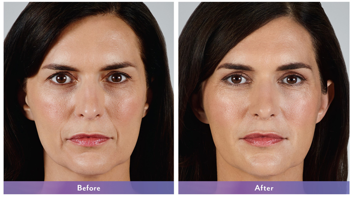 Best Botox | Before and After | Lincolnwood IL | ForeverYoung MedSpa photo