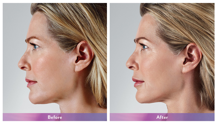 Best Botox | Before and After | Lincolnwood IL | ForeverYoung MedSpa