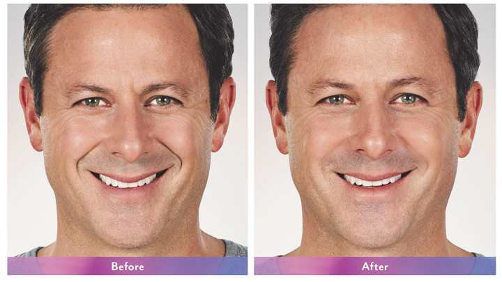 Best Botox | Before and After | Lincolnwood IL | ForeverYoung MedSpa photo