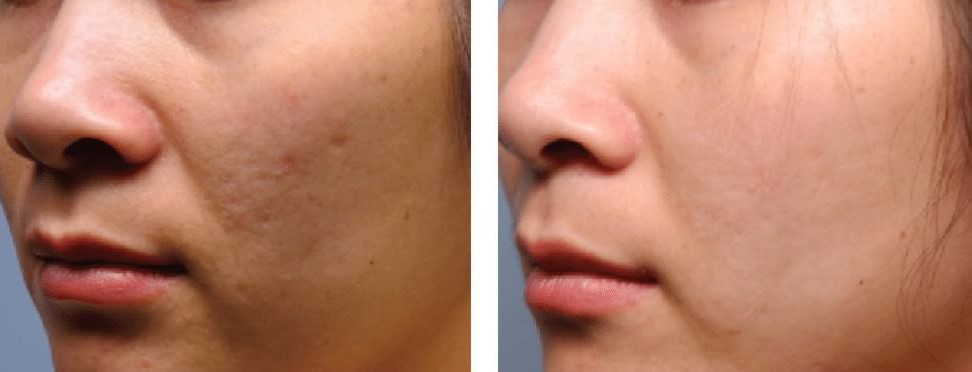 before_and_after_dermaplaning2