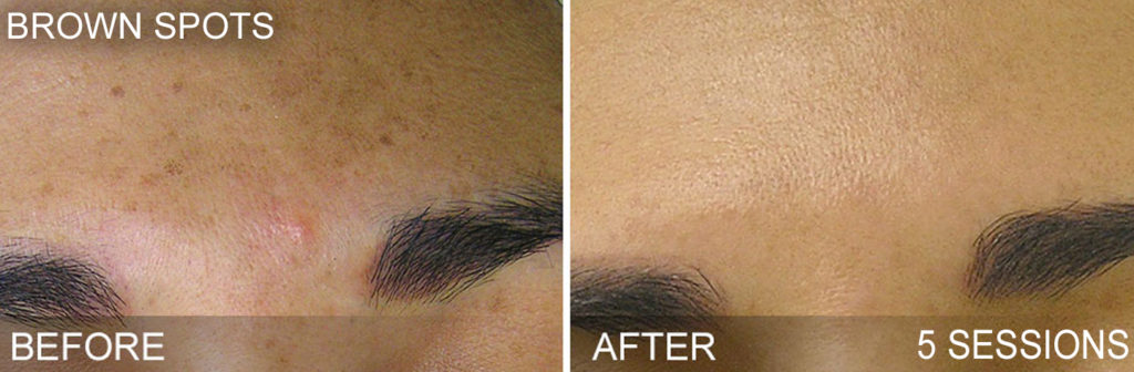 brown_spots_before_and_after1