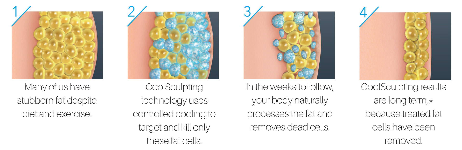 Graphic showing how coolsculpting work, freezing fat cells that naturally eliminate from the body and shrink permanently.