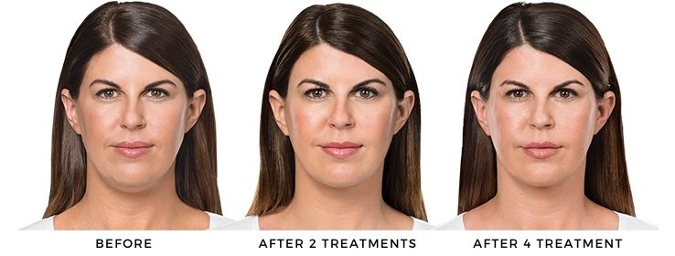 Woman's before and after results from kybell at forever young medspa in deerfield, IL.