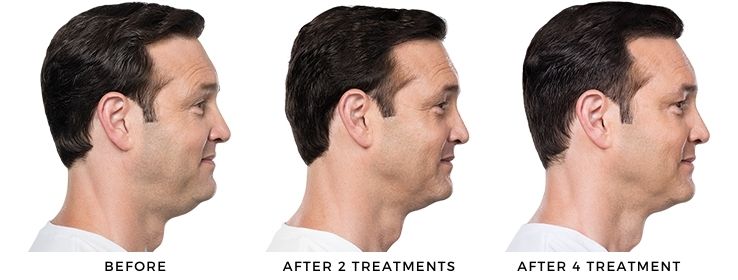 Man's before and after results from kybell at forever young medspa in deerfield, IL.