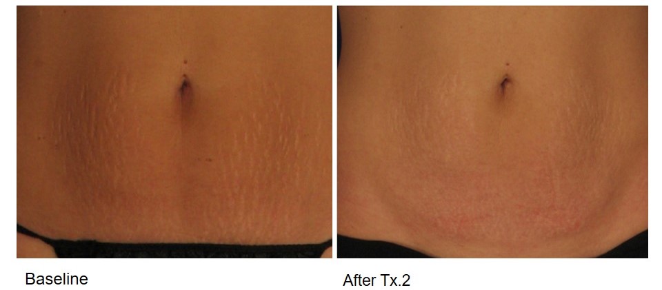 Skin resurfacing before and after on the abdomen.