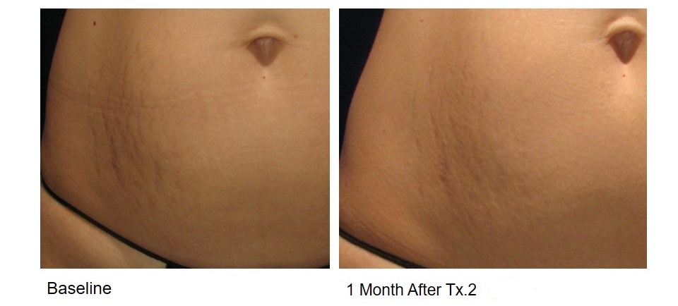 Skin resurfacing before and after on the abdomen.